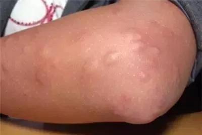 海南小黑虫咬人怎么防御,看到有小黑虫钻进伤口怎么办