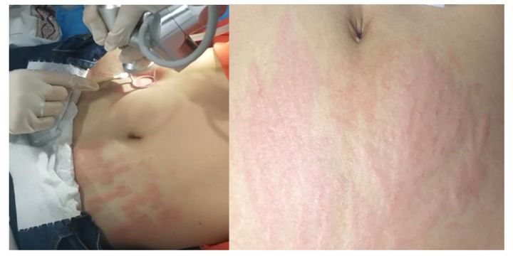 不想长妊娠纹该怎么增加体重,不想长皱纹要怎么做