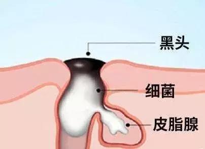 你知道黑头是怎么形成的吗,怎么分辨黑头的严重程度