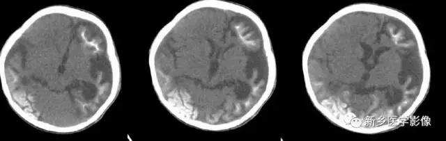 脑室为什么会扩张,脑室为什么会变小