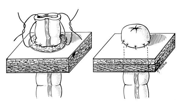 造口患者的心理,造口人真的存在心理障碍吗