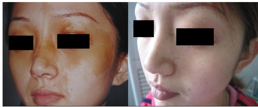 此“咖啡”非彼“咖妃”，今天来说说咖啡斑