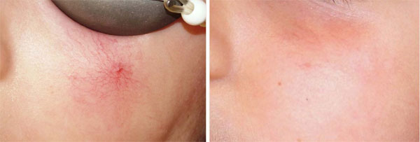 肝硬化出现蜘蛛痣是什么原因,肝硬化有蜘蛛痣的概率有多大