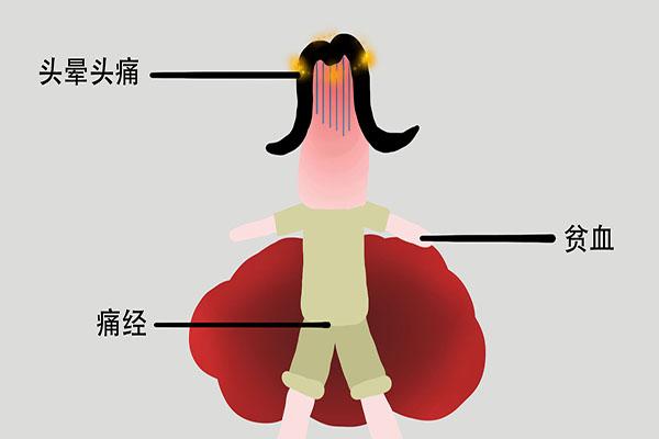 轻度脑梗前期的征兆是什么样的,得了脑梗轻度的要注意哪些方面