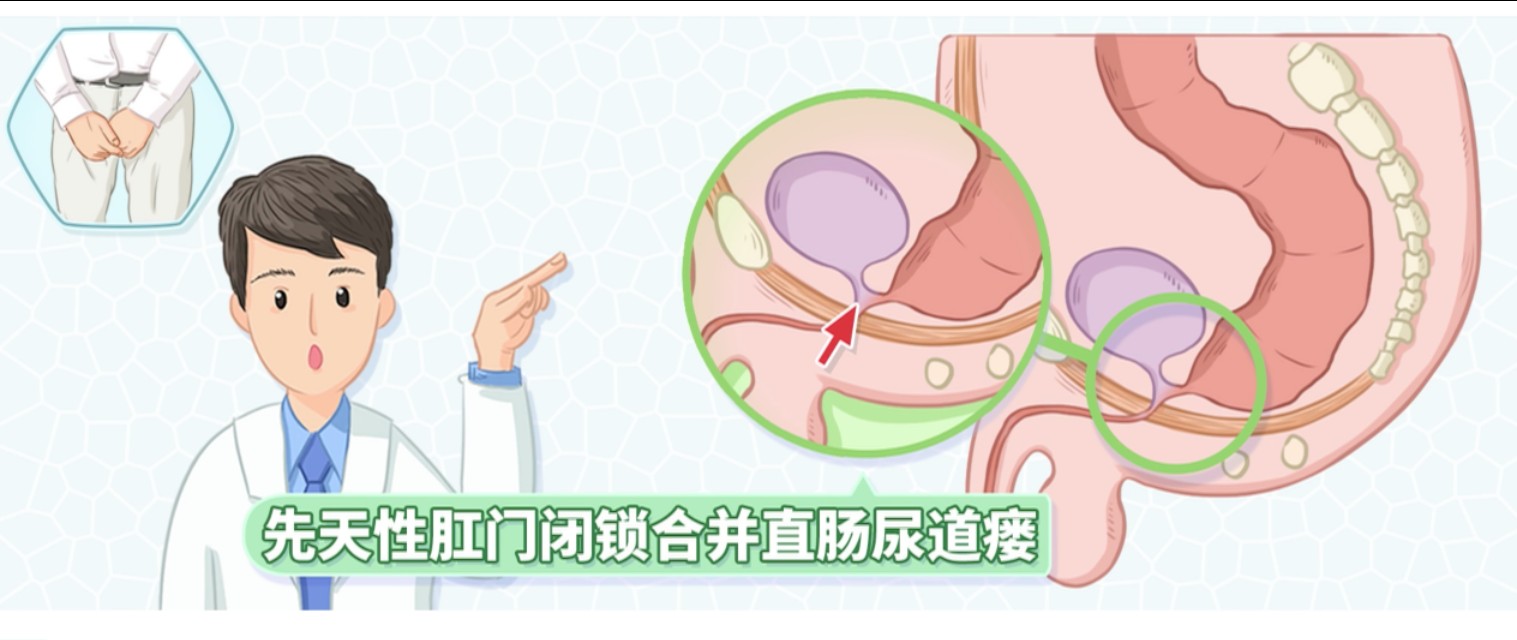 直肠尿道瘘轻的症状,尿道直肠瘘会死人吗