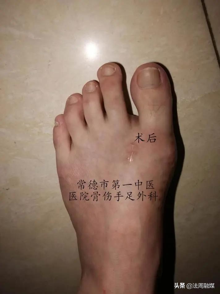 拇指长歪了?别慌!常德市第一中医医院专家帮您改“邪”归正