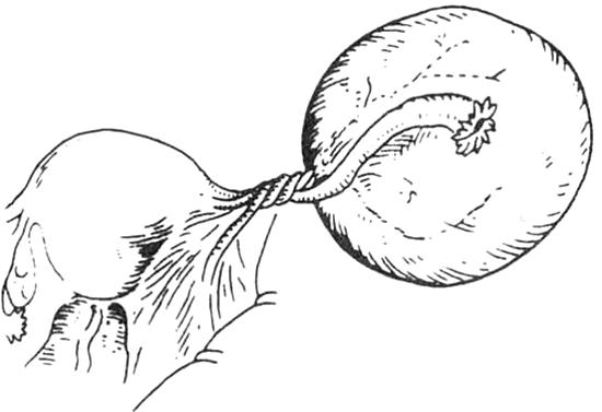 卵巢囊肿和卵巢冠囊肿有什么区别,卵巢巧克力囊肿和卵巢囊肿的区别