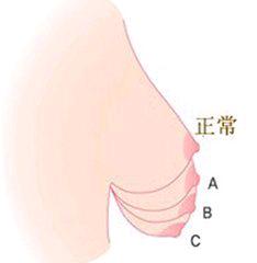 关于胸部是否下垂知识,关于胸部下垂