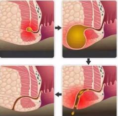 “老鼠偷粪”,这是个啥病?