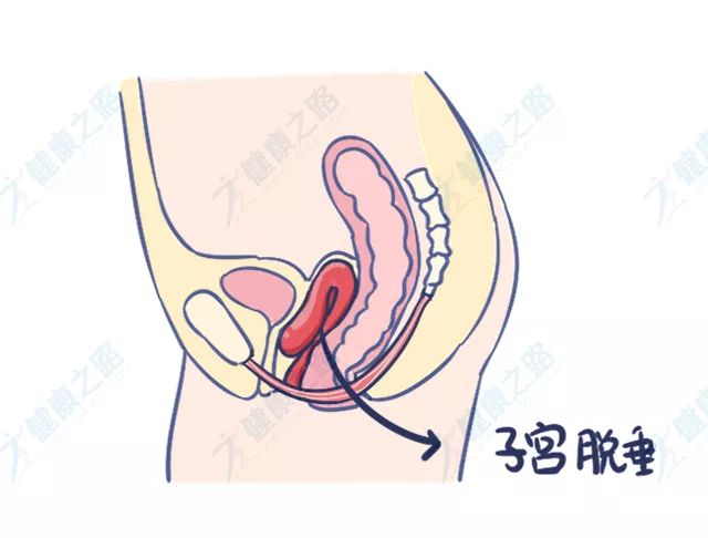 松了咋办,太松怎么收紧的妙招
