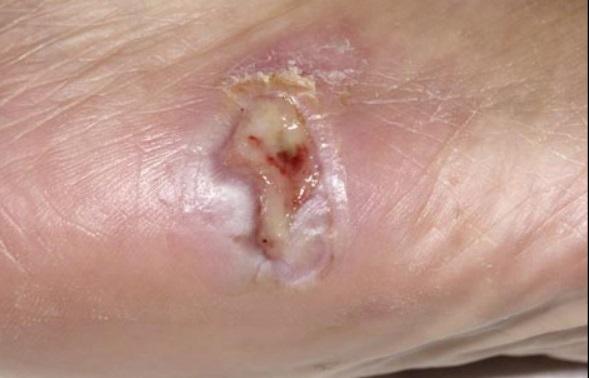 脚上有病有什么征兆,脚上有这三种症状赶紧去医院