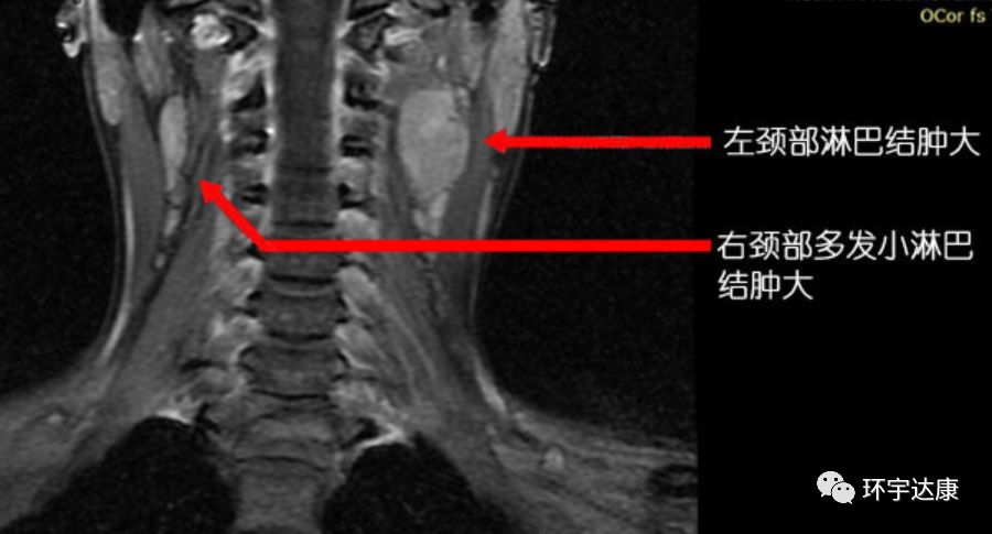 全国治疗鼻咽癌排行榜,鼻咽癌全球发病率最高的地区是