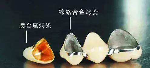 不含重金属的烤瓷牙有吗,诊所100元一颗的烤瓷牙有毒吗