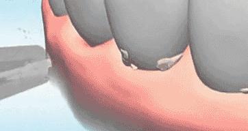 智齿蛀牙痛有什么有效方法止痛,智齿旁边牙松动蛀牙如何处理