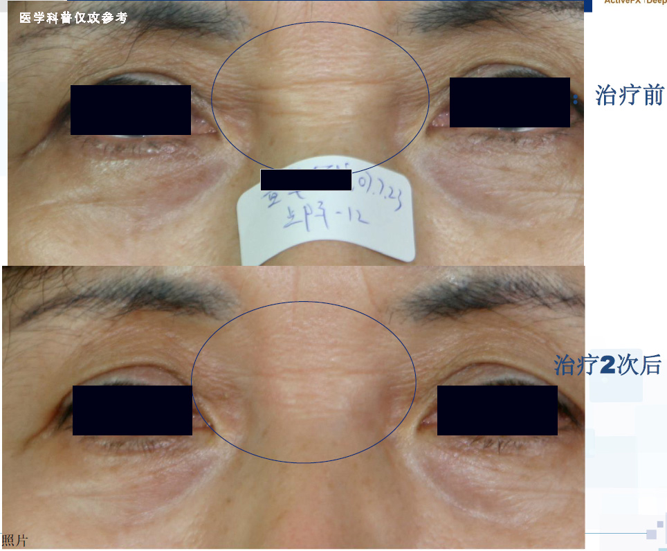 超脉冲co2点阵激光可以祛妊娠纹吗,脉冲点阵激光和co2点阵激光
