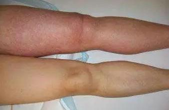 动脉压迫静脉什么原因,下肢动脉闭塞会引起小腿肿吗