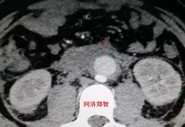 磁共振可以替代cta检查主动脉夹层,超声心动图联合cta诊断主动脉夹层