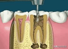 每逢节假日就牙痛?如何在节假日既能享受美餐又能健康口腔