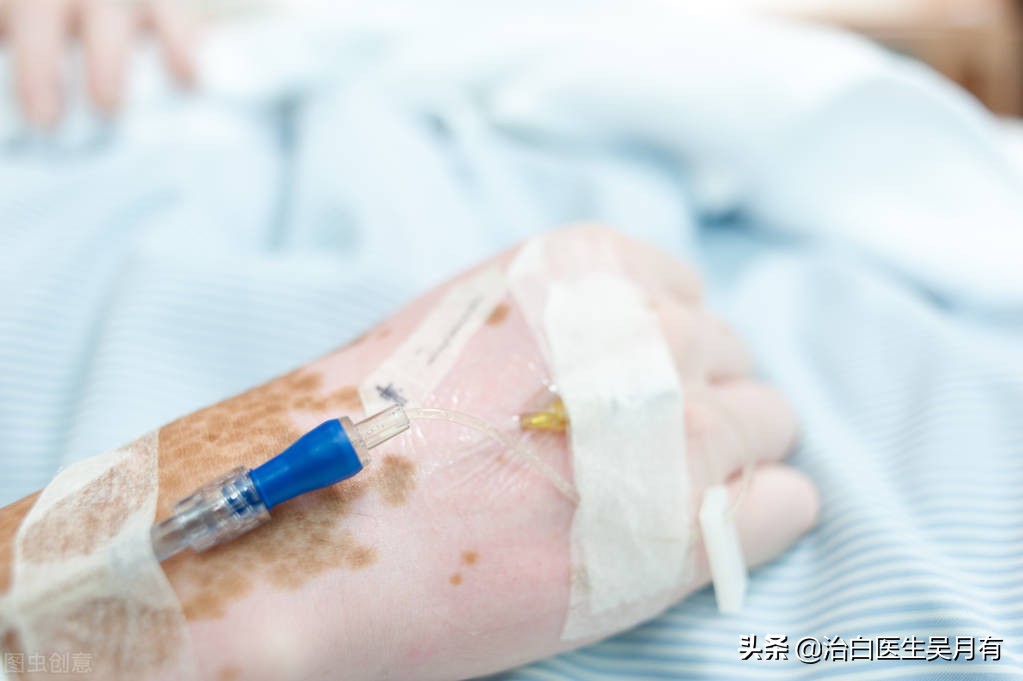 为什么用药了反而越来越严重,为什么感觉用了药膏白癜风会扩散