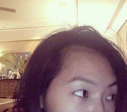 陈奕迅秃顶头发稀疏,陈奕迅同款发际线怎么补救