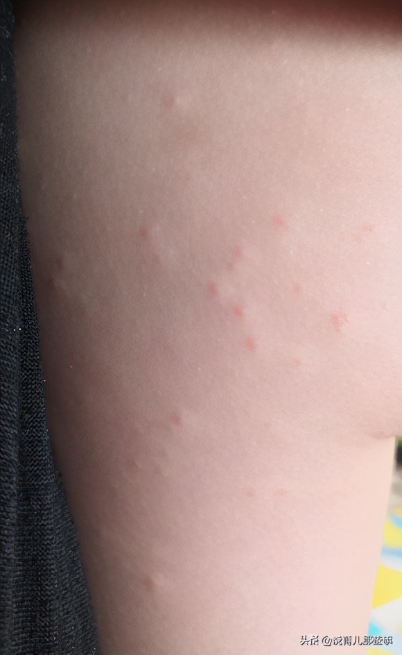 很恐怖的过敏图片,过敏发朋友圈的真实图片