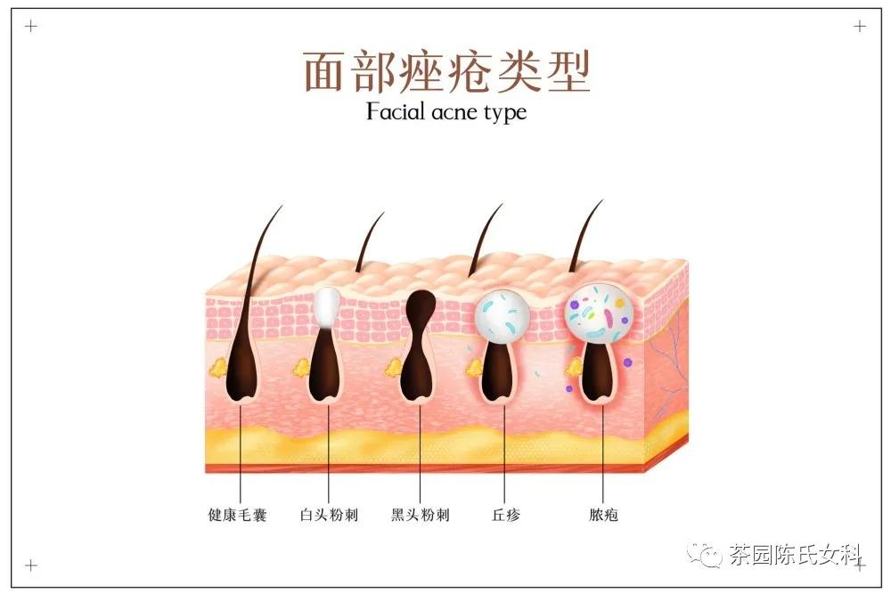 火针的应用范围,中医火针应用