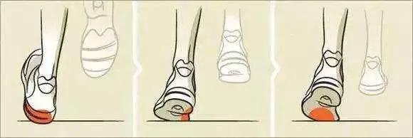 关注“跑偏”的鞋子,提示你的健康问题!