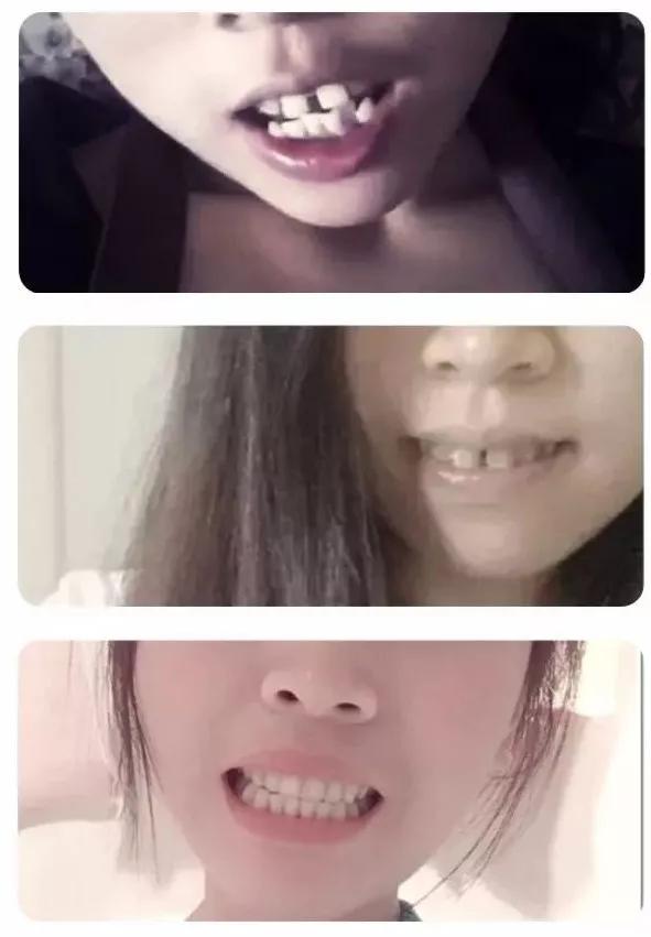 雅悦齿科矫正牙齿好不,上海牙齿矫正保持器要戴多久