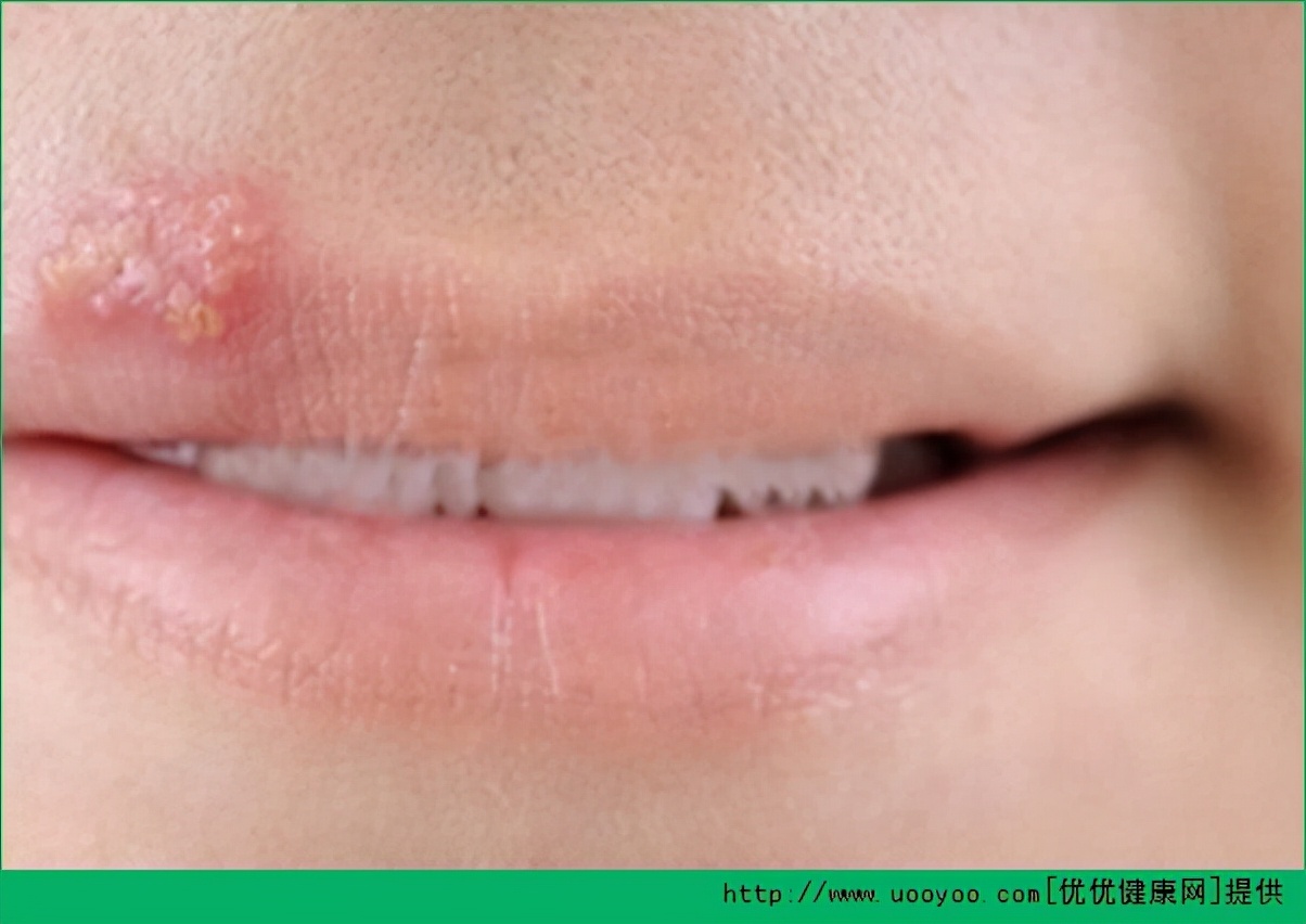 战痘的正确方法图解,五个“战痘”小妙招