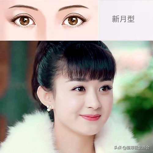 关于双眼皮你应该知道的有哪些,做双眼皮必须知道的三件事