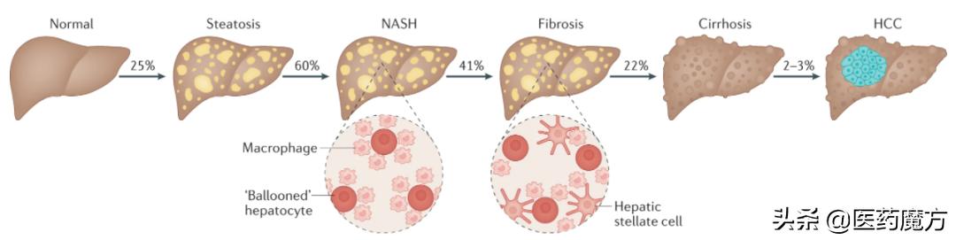 nash创新疗法2期,nash新药研发