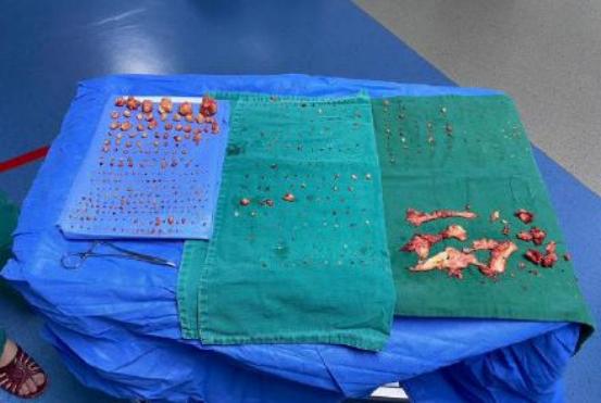 女性体内取出71个肌瘤,手术中挖出的子宫肌瘤