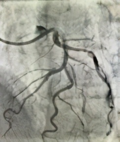 oct在冠脉介入的应用,广西冠脉介入治疗