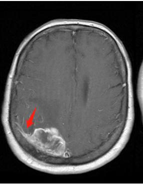 脑膜瘤有些什么症状,脑膜瘤症状有哪些啊