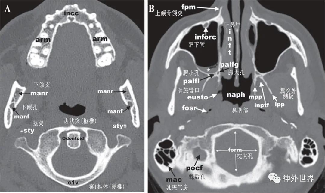 颅底骨折合并脑脊液漏伤情鉴定,颅底骨折伴脑脊液漏右眼眶骨折