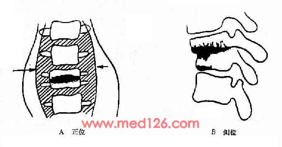 关节疼风湿怎么治疗完全治愈,关节疼是不是风湿病查啥