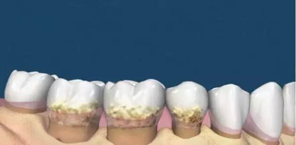 洗牙到底怎么洗好,洗牙洗的不干净