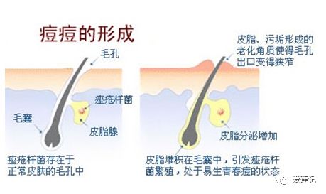黑头挤不掉怎么办,棉签挤白头黑头
