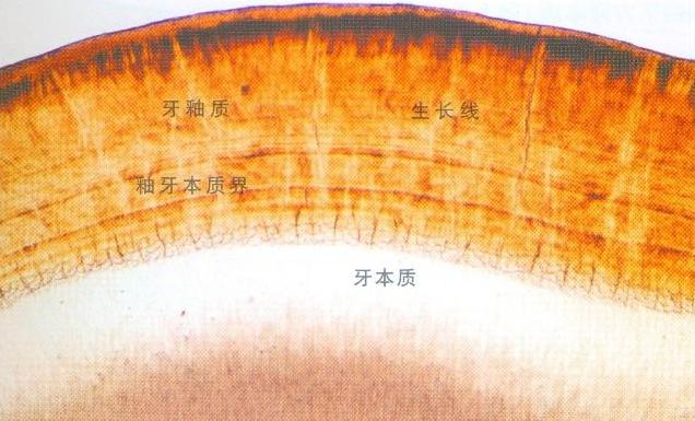 损伤了牙釉质该怎么修复,关于牙釉质损伤怎么修复