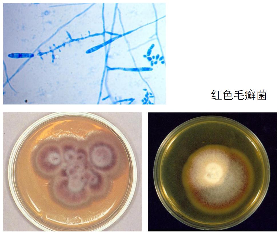 及时治疗脚气，是对家人最好的负责