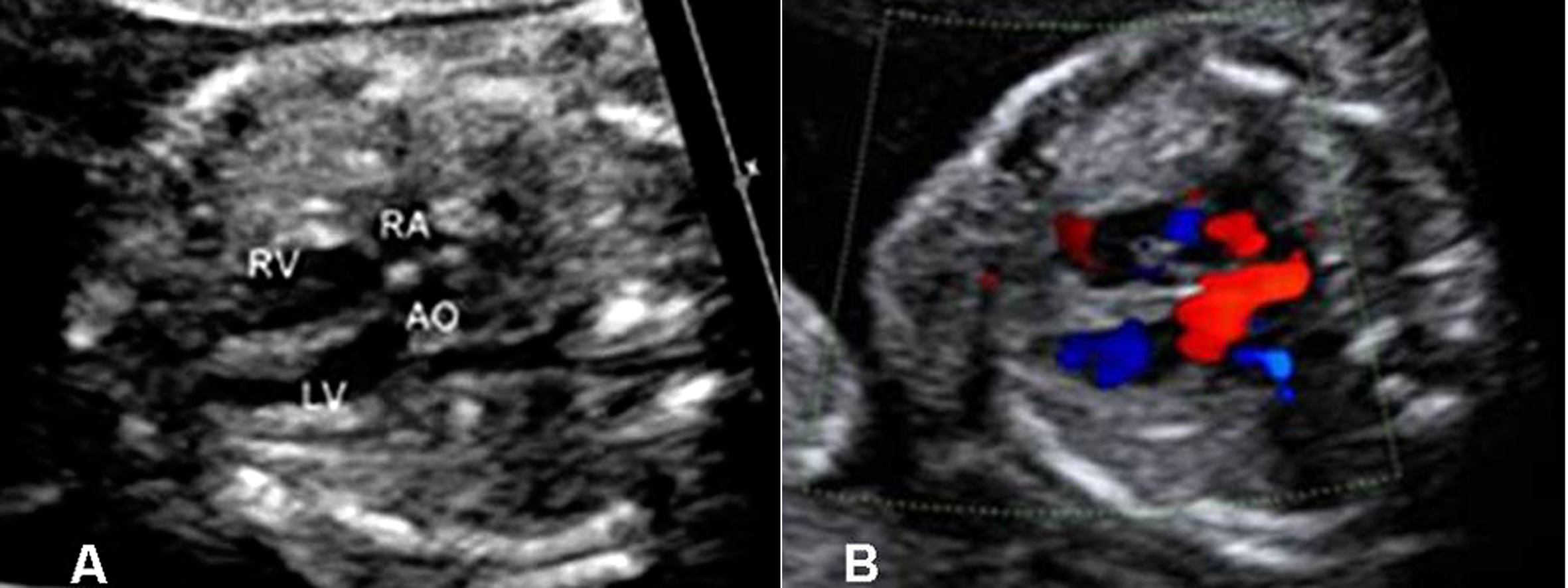 做普通的彩超能不能看到胎儿心脏,做彩超能知道胎儿准确多少周吗