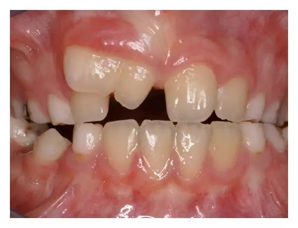 牙齿长成包谷牙怎么办,牙齿长成了双排牙如何矫正