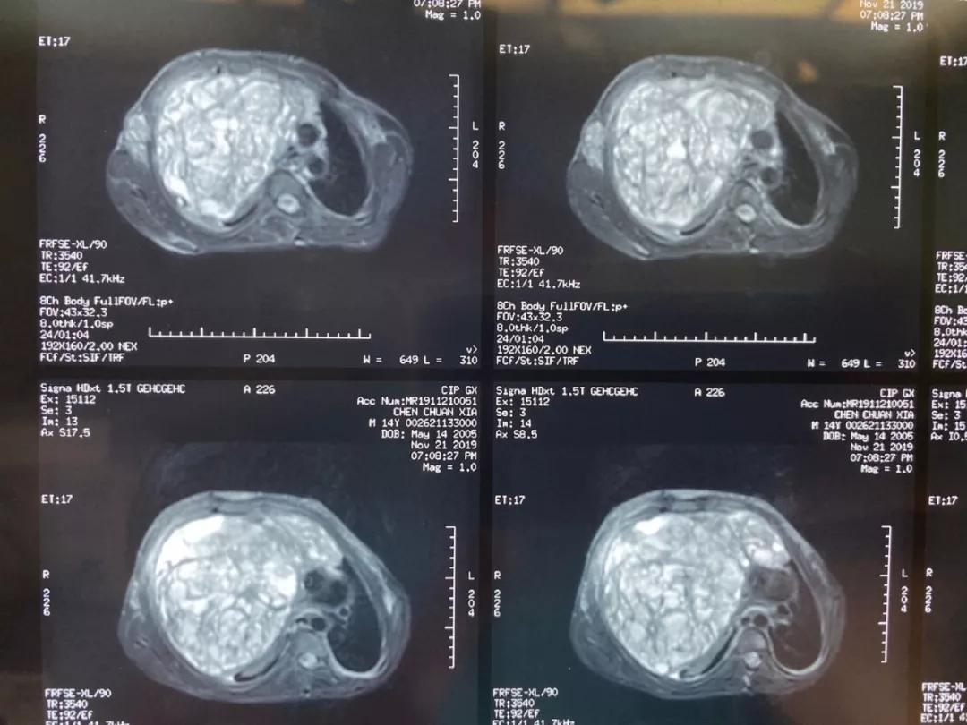 15岁男孩腹部肿瘤20公分后续,男孩巨大肿瘤手术后续