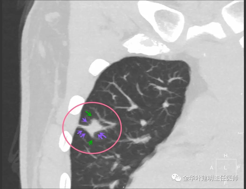 叶建明谈肺结节:一招分辨隐球菌性肉芽肿与肺癌