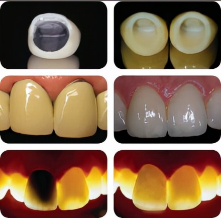 如果不满足种植牙条件缺牙怎么办,种植牙几百几千上万有什么区别