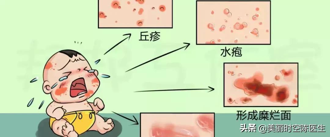 皮肤病中的“孙悟空”