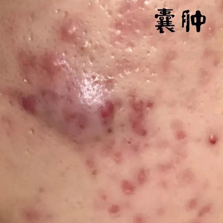 为什么你的痘印总是消不下去,为什么你的祛斑效果不理想