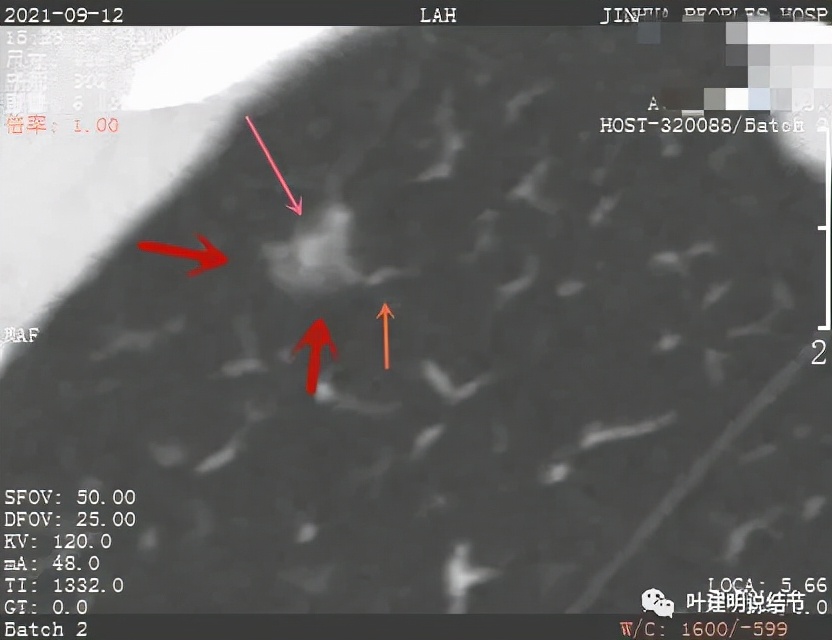 怎样从病理报告看是不是原位癌,原位腺癌切除子宫要开刀吗