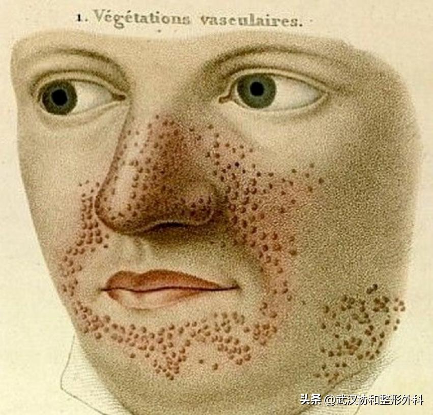 咖啡牛奶斑一定是神经纤维瘤吗,咖啡牛奶斑会突然出现吗