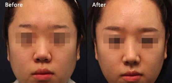 打瘦脸针3次真的可以永久定型吗,瘦脸针打三次真的能定型么